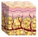 Etapas de la celulitis Epidermis con celulitis y piel rugosa