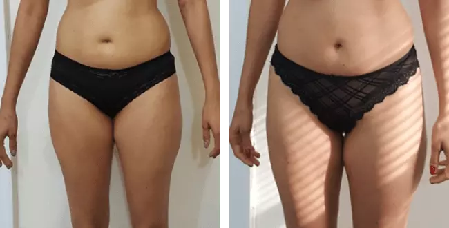 Antes y después del abdomen después de utilizar Glo 910 PLus